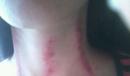 扭痧视频,轻松掌握居家养生新技能